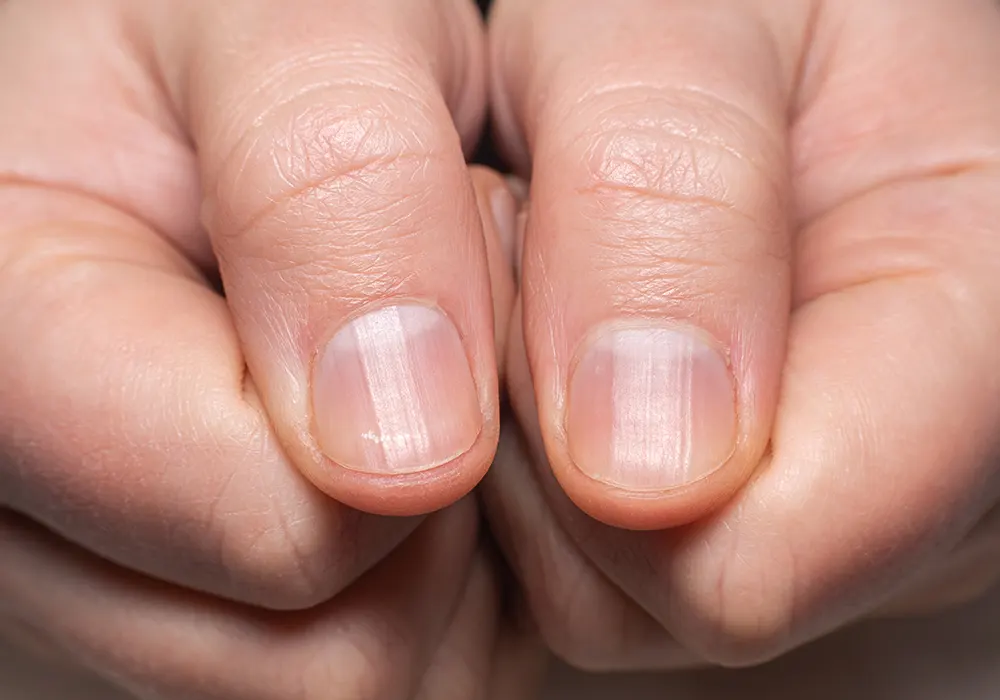 cause of vertical nail ridges