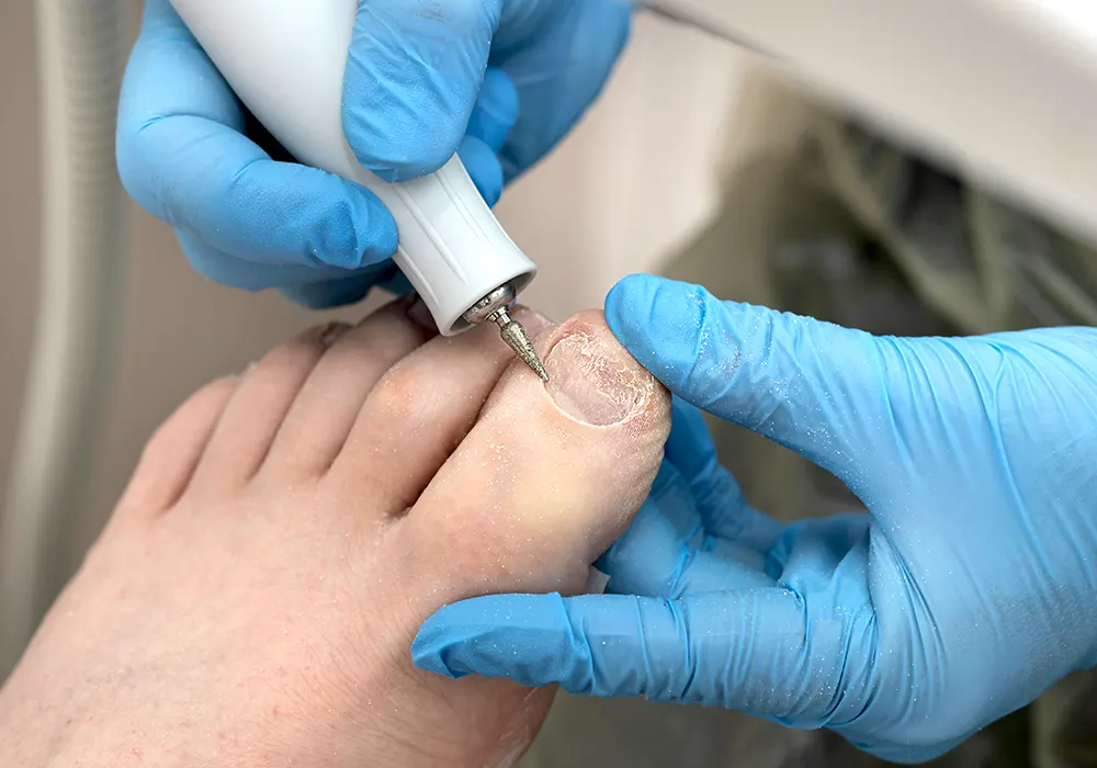 Melanonychia treatment in Toenails