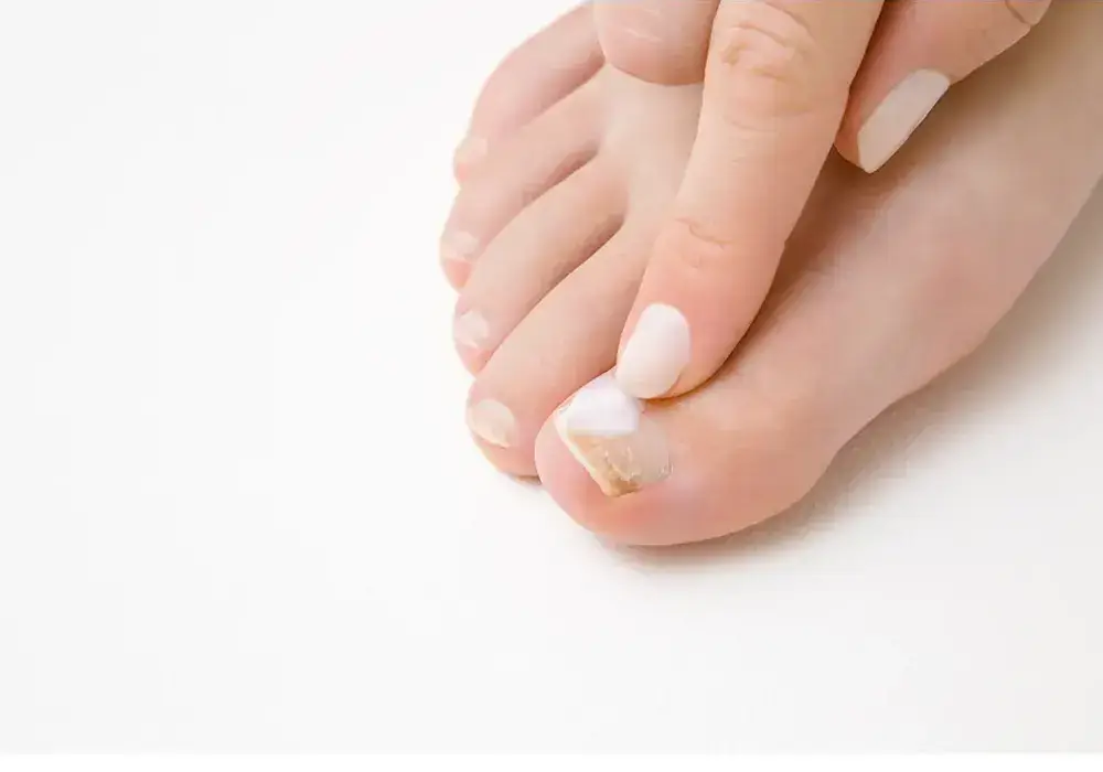 Nail discolouration topical treatment