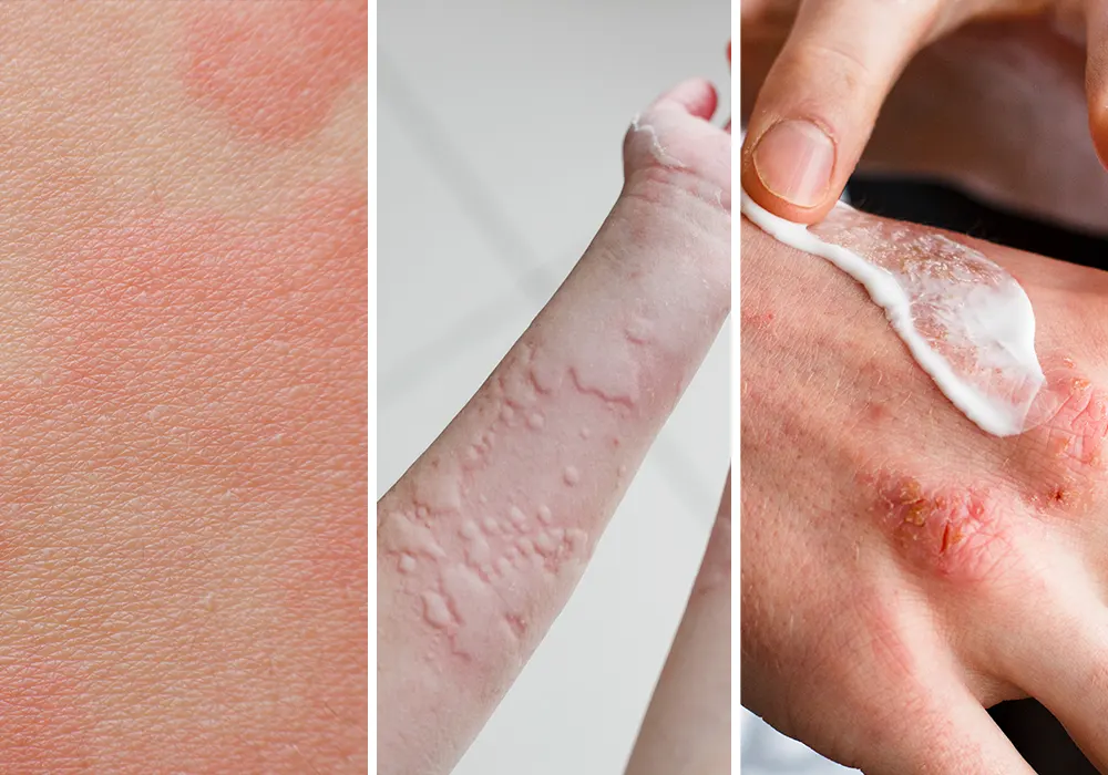 Common skin allergy symptoms