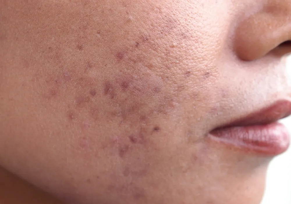 open pores on skin