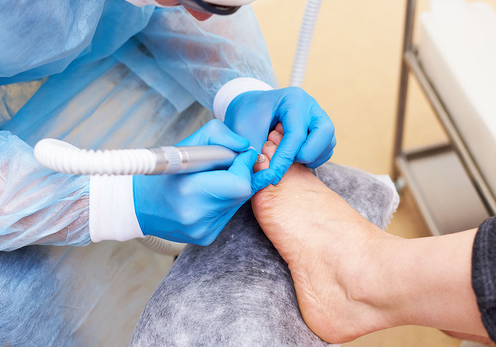 Ingrown toenail treatment at Dr Tina Skin Solutionz