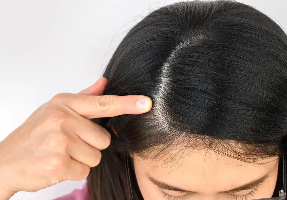 telogen effluvium hair loss