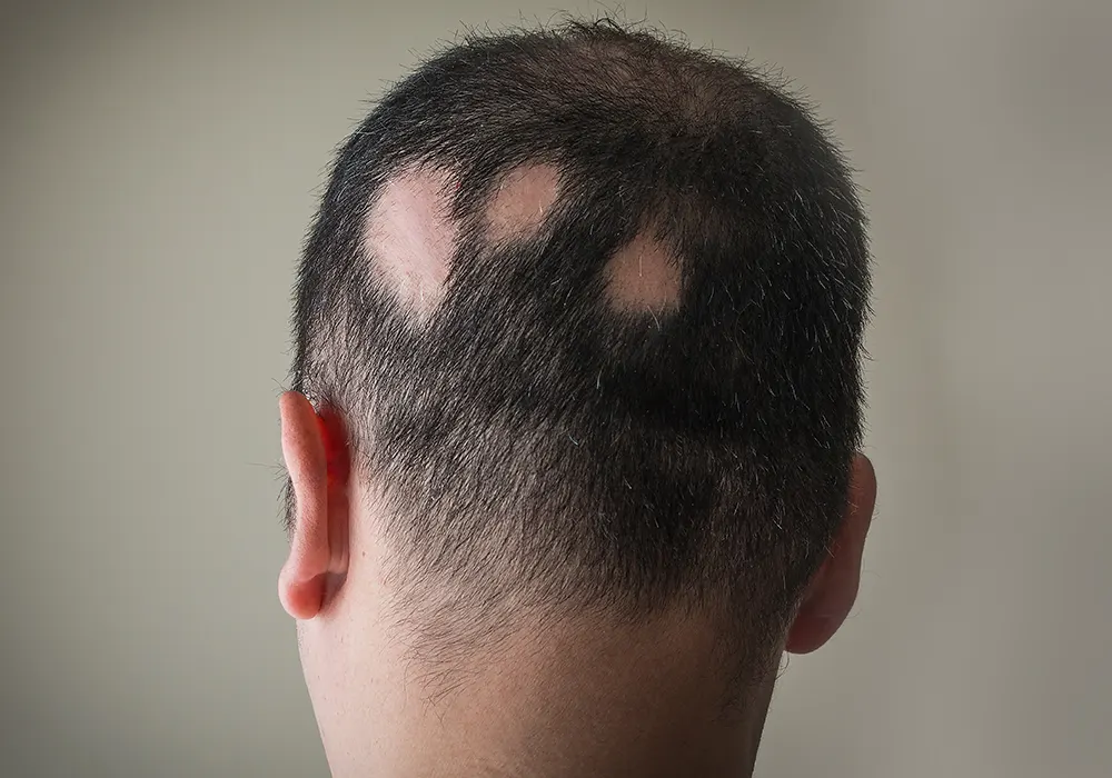 Alopecia Universalis treatment in Bangalore