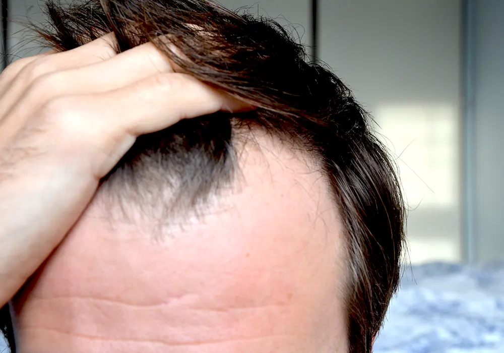 Patterned hair loss in men