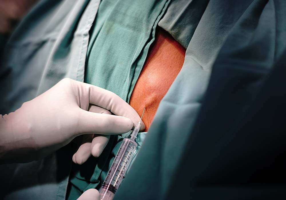 Cyst excision treatment procedure